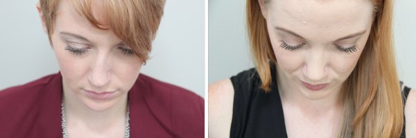 Rhinoplasty Before & After Photo 95