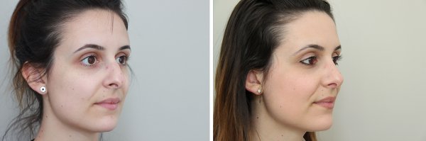 Rhinoplasty Before & After Photo 96