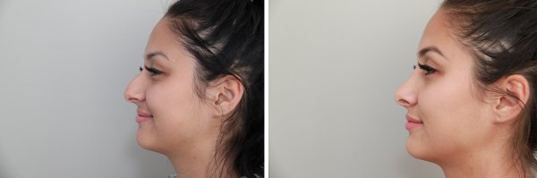 Rhinoplasty Before & After Photo 97