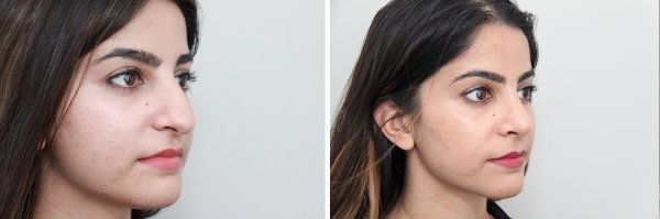 Rhinoplasty Before & After Photo 99